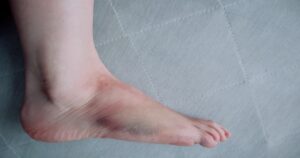 打撲による内出血（青あざ）の症状と回復のイメージ